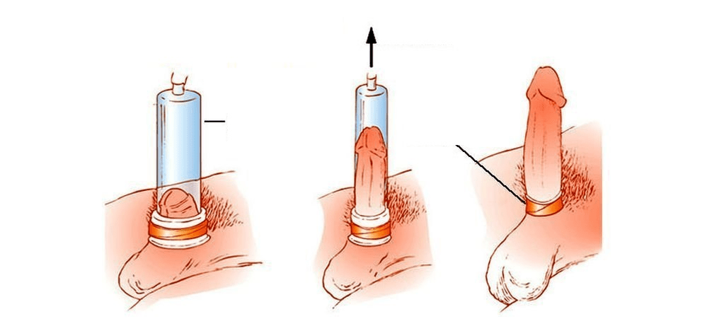 como funciona unha bomba de baleiro para a ampliación do pene