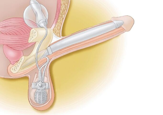 prótesis de pene para agrandamento