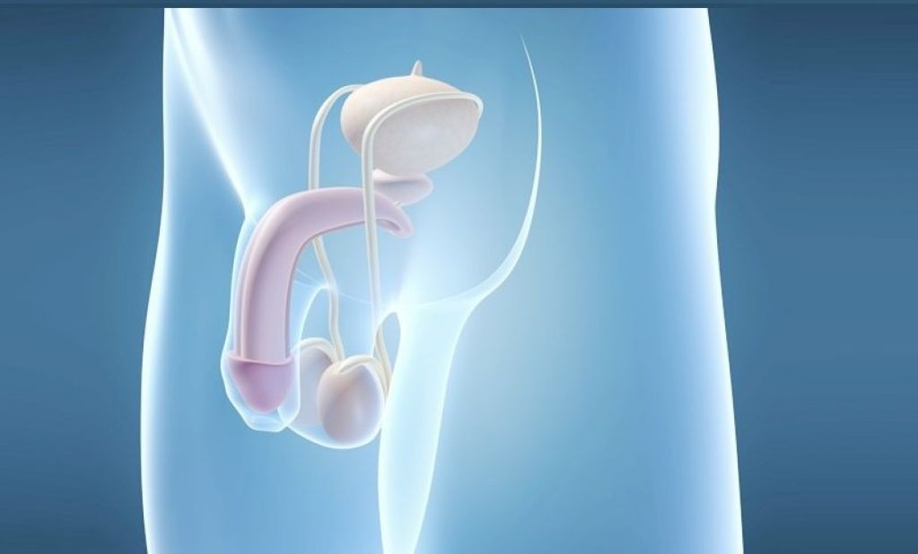 A implantación de prótese é un método cirúrxico para agrandar o pene masculino