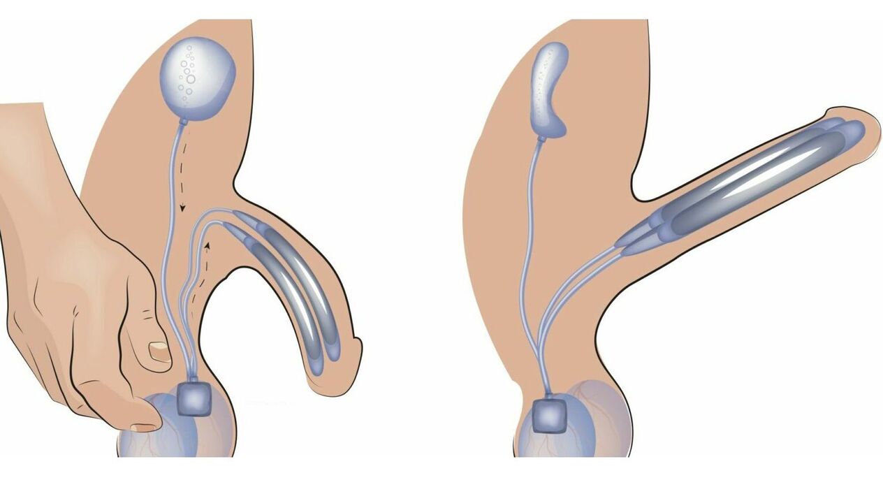 prótese de pene para a ampliación do pene