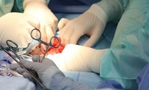 a ampliación do pene cirurxía